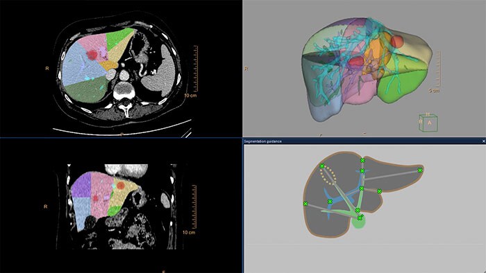 liver analysis thumbnail