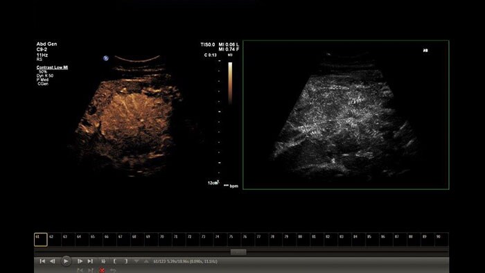 q-app microvascular imaging thumbnail