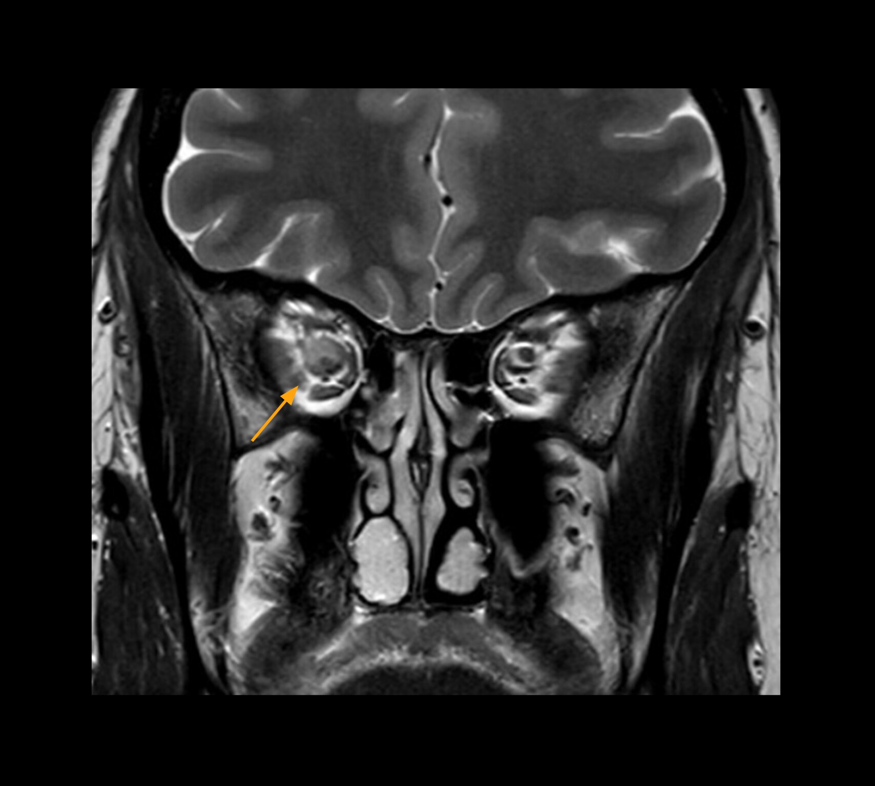 Optic nerve mri one