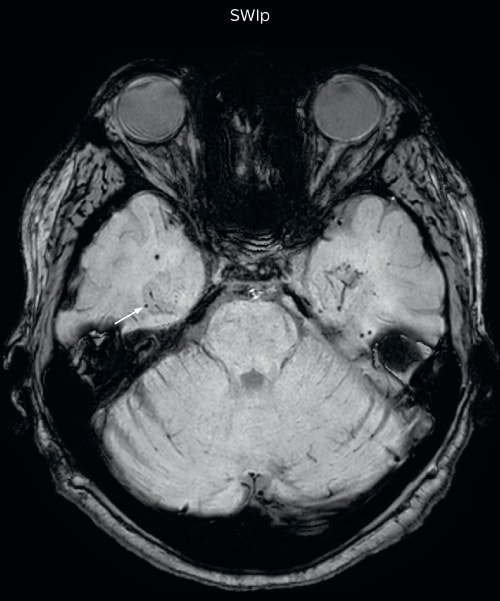 mri protocols UVM case SWIp hemosiderin foci in brain1