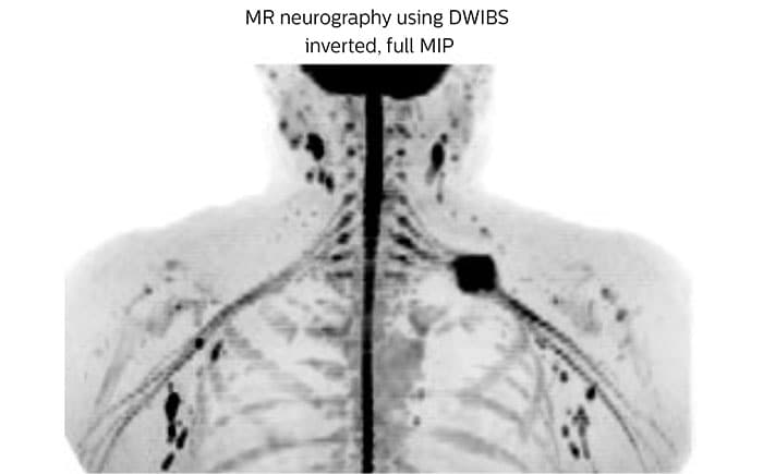 magnetic resonance neurography using DWIBS inverted, full MIP