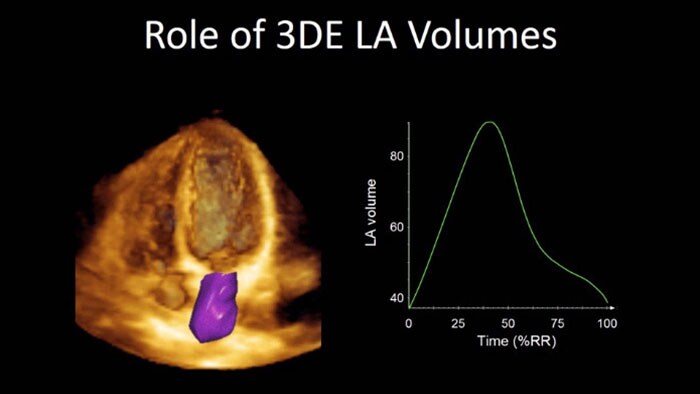 Role of 3DE LA Volumes