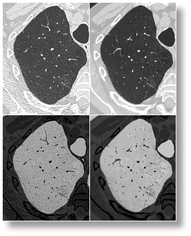 Emphysema - Ground Glass Nodule