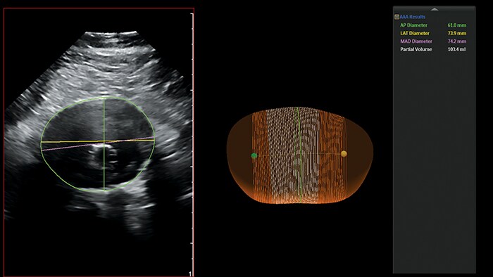 Ultrasound AAA image
