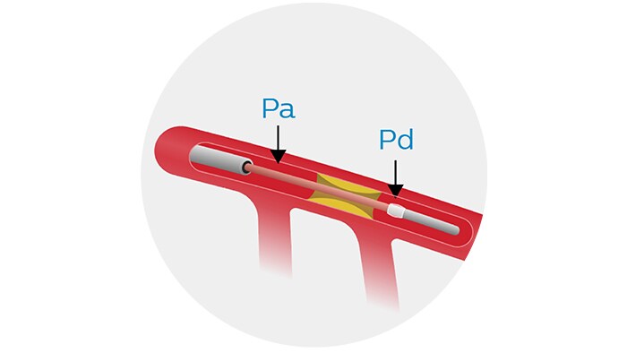 coronary pressure