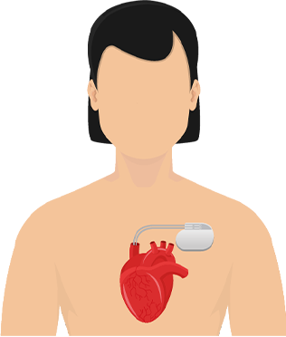Cardiac device animation