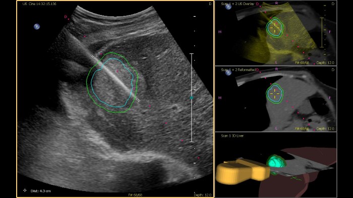 Tumor Contour