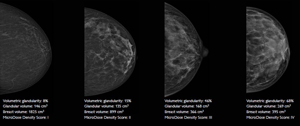 spectral imaging microdose si spectral imaging breast density measurements LM